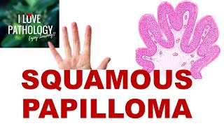 SQUAMOUS PAPILLOMA Etiopathogenesis Clinical Features and Pathology [upl. by Arrait206]