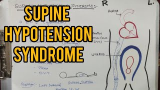 Supine Hypotension syndrome  Femoral vein Pressure  Position during pregnancy [upl. by Nessah]