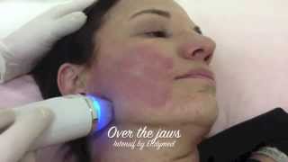 Intensif RF MicroNeedling from EndyMed [upl. by Buffum842]