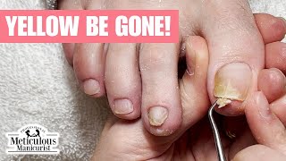 Why Are My Toenails Turning Yellow nails satisfying [upl. by Sumetra]