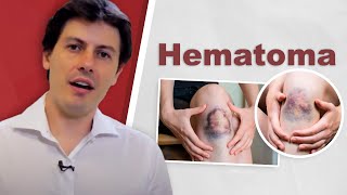 Hematoma Dr Fernando Amato [upl. by Tniassuot325]