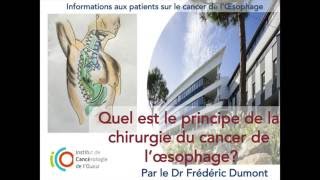 Quel est le principe de la chirurgie du cancer de loesophage [upl. by Mikkanen571]