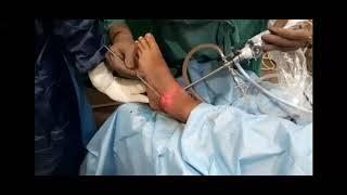 Ankle Arthroscopy Basics Portals Placement amp surgery for Ankle Impingement [upl. by Brill]