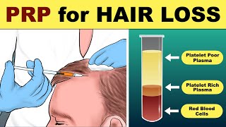 PRP Hair Treatment  prp hair loss treatment before and after  Hair loss Treatment [upl. by Callas273]