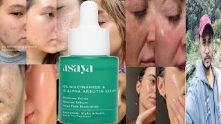 Asaya 10 Niacinamide 1 Alpha Arbutin Serum  Honest Review [upl. by Eerihs141]