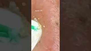 Pickel Ausdrücken Blackheads Akne amp Mitesser entfernen 🔴 24 [upl. by Attennyl]