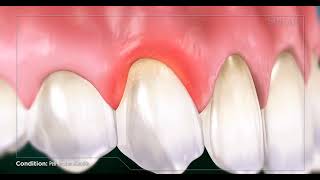 PeriImplant Mucositis [upl. by Nilat]