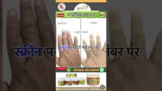 Eczema ayurvedic skin care [upl. by Boice]