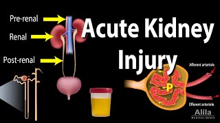 Acute Kidney Injury aka Acute Renal Failure Animation [upl. by Melgar]