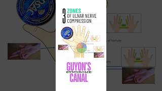 Guyon’s canal syndrome three types of ulnar nerve injury in pisohamate hiatus shorts [upl. by Ittocs785]