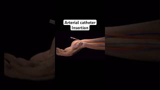 Arterial catheter insertionshorts ytshort anesthesia [upl. by Ahsienom]