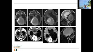 Role of Neuroendovascular Treatment in Intracranial Hypertension and Pseudotumor Cerebri [upl. by Arlinda]