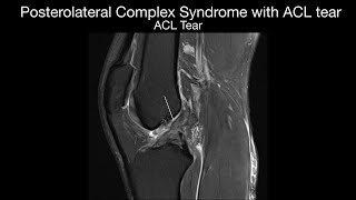 Posterolateral Corner Syndrome with ACL Tear [upl. by Rosie]