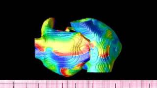 Atrial fibrillation simulation in an anatomical human atria [upl. by Yruama]