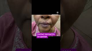 Lip stick Dermatitis  lip eczema  lipcare  Dermatologist in Punjab  Dr Ashima Goel [upl. by Stiegler]