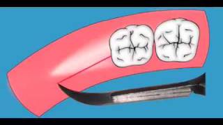 Distal Molar Surgery part 3mov [upl. by Dlanigger641]