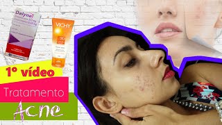 1ª Video Tratamento da acne com Tetraciclina e Creme Adapaleno [upl. by Ahron]