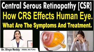 Central Serous Retinopathy  Causes Symptoms amp Treatment  CSR  Best Vision Eye Hospital [upl. by Martynne]