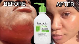 Even TONE skin✨AmLactin Daily 12 lactic Acid MoisturiZing lotion 2023ReviewRoughdrySkinspotless [upl. by Ferdy146]