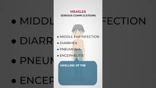 Complications from measles [upl. by Trocki]