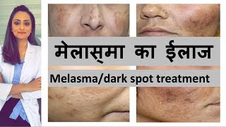 काले दाग का ईलाज  Melasma dark spots  pigmentation Causes amp Treatment Hindi  Dr Aanchal Panth [upl. by Bendicty]