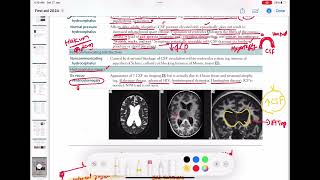 ex vacuo ventriculomegaly neurology 104  First Aid USMLE Step 1 in UrduHindi [upl. by Arsuy]