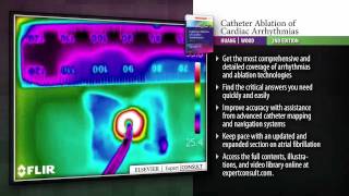 Catheter Ablation of Cardiac Arrhythmias 2nd Edition [upl. by Airrej]