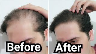 How I Grew Back my Hair with Rosemary Oil My Results w Pictures Before amp After  How To Use [upl. by Akihsal]