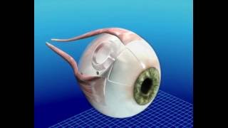 Molteno3 Glaucoma implant bleb formation animation [upl. by Lundgren]