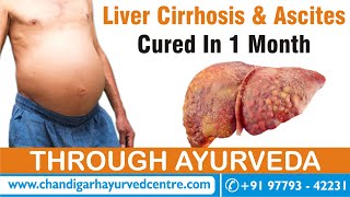 Ascites and Liver Cirrhosis Cure Through Ayurveda Real Testimonial [upl. by Fifi]