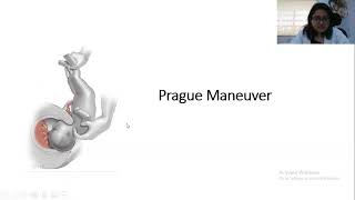 Obstetric maneuvers  Quick revision for NEET PG [upl. by Retxab]