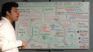 Tumores Hipofisiario o Masas de la región Sellar Glándula Pituitaria  MacroadenomaMicroadenoma [upl. by Reni]