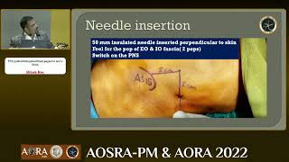 PNS GUIDED ILIOINGUINAL ILIOHYPOGASTRIC NERVE BLOCK [upl. by Assirehs]