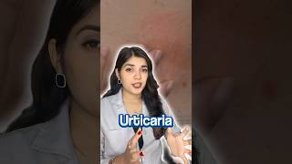 How I Cured My Urticaria Chronic Hives  My Story [upl. by Terrag]