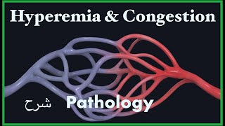 Pathology  Congestion amp Hyperemia  Hemodynamic blood disorders 3 شرح باثو [upl. by Lindgren]