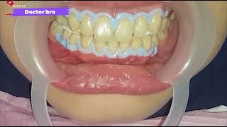 Best way to clean teeth  SCALING  Oral Health [upl. by Guimond13]