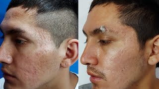 🔥 El MEJOR TRATAMIENTO para CICATRICES DE ACNE y otras 2021✅ DERMAPEN  SUBCISION  ANTES Y DESPUES [upl. by Elaynad]