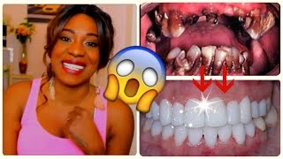 Astuce INCROYABLE DENTS POURRIES À DES DENTS BLANCHES DE STAR [upl. by Kcirderfla]