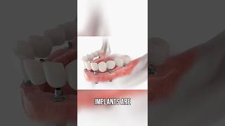 Affordable Dental Implants Are In Denver Dont Miss Out [upl. by Swords]