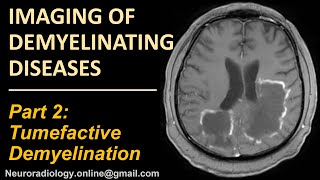 Imaging of Tumefactive Demyelination [upl. by Phi753]