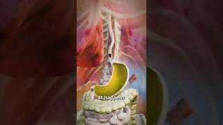 Acid Reflux Explained 🔥🤔 Causes Symptoms and Treatments [upl. by Hnamik]