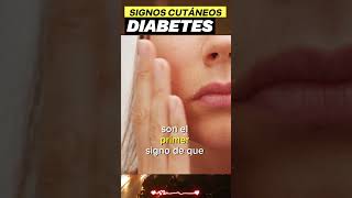 Signos Cutáneos y Síntomas Comunes de la Diabetes Tipo 2 [upl. by Kial492]