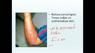 Bullous dermatosis [upl. by Alle584]