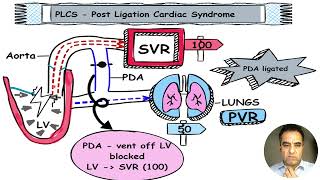 What is Post Ligation Cardiac Syndrome in Neonates [upl. by Hagai]