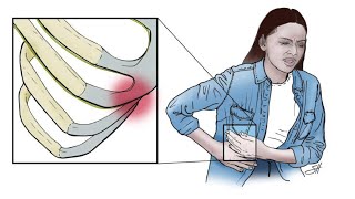 Costal Margin Reconstruction for Slipping Rib Syndrome [upl. by Thamos589]