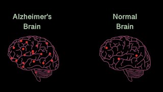 Neuroinflammation in Alzheimers Disease  My Research Video Contest [upl. by Surat]