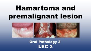 Oral Pathology 2  LEC 3  Classification of Hamartoma and premalignant lesion [upl. by Eecal]