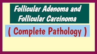 Follicular Adenoma And Follicular Carcinoma  Thyroid Neoplasm [upl. by Cardew33]