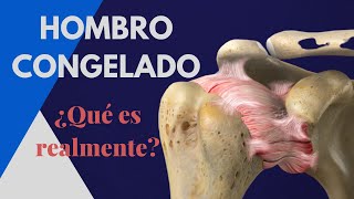 HOMBRO CONGELADO ¿Qué dice la CIENCIA Diagnóstico causas duración y tratamiento [upl. by Ditter]