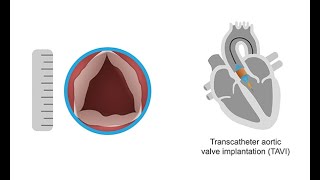 Evaluating the aortic valve using 3D echocardiography [upl. by Tabbatha]